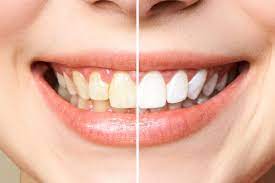 With more serious forms of the disease, it is possible to change the color of the teeth, the appearance of brown. Dental Fluorosis The Causes And The Treatment