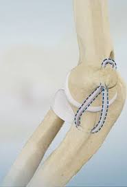 This procedure involves making multiple incisions, harvesting a tendon graft, and drilling holes for a place this tendon graft will fit into. Ucl Reconstruction Cincinnati Tommy John Surgery West Chester Ucl Injury Dayton