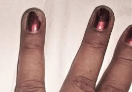 nail diseases in women springerlink