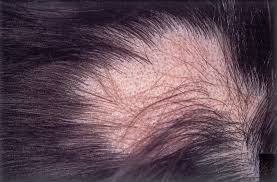 alopecia areata types symptoms