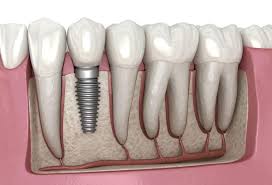 implanturi dentare cluj clinica