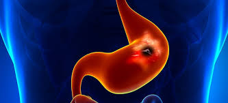 stomach ulcer symptoms causes and