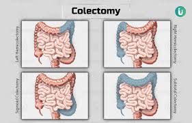 colectomy procedure purpose results
