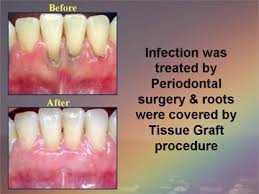 periodontal gum disease treatments z