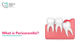pericoronitis treatment causes and