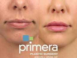 juvÉderm dermal filler for orlando