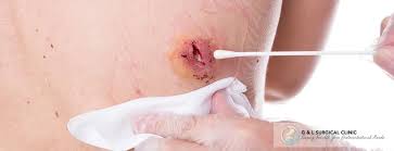skin abscess removal singapore g l