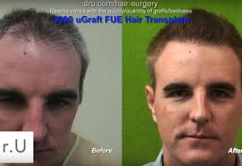 Both males and females can benefit from hair transplant surgery. Hair Restoration What You Should Know Dermhair Clinic Los Angeles