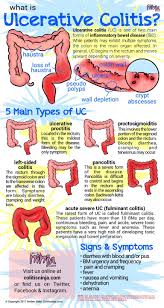 Ulcerative Colitis Ulcerative Colitis Ulcerative Colitis