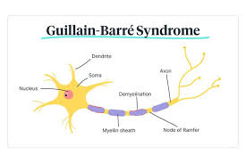 Yuki n., kokubun n., kuwabara s. Guillain Barre Syndrome What Is Gbs Ausmed