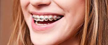 When you first get your braces braces removal: Braces Pain 10 Ways To Relieve Mouth Pain From Braces