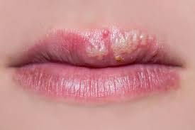 how to handle lips blisters after pmu