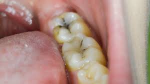 Cavities happen to us all. Black Dot On Tooth What Does That Dark Spot Mean