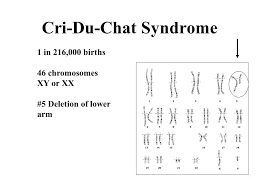 Turners Syndrome 1 In 5 000 Births 45 Chromosomes X Only 23