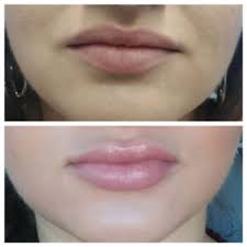 lip filler injections 5 things to know