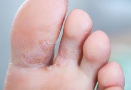 Nail fungus is a common condition that begins as a white or yellow spot under the tip of your fingernail or toenail. How You Can Stop Foot And Toenail Fungus In Its Tracks Health Essentials From Cleveland Clinic