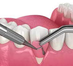 flap surgery meraki dental studio
