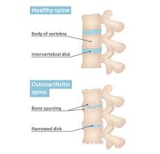 spinal osteoarthritis physiopedia
