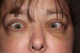 thyroid eye disesase patient information