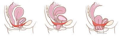 what is a pelvic organ prolapse is