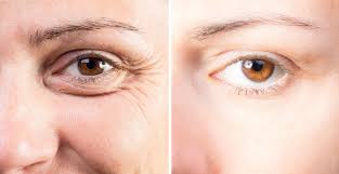 can eyelid lifts affect your vision