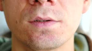 skin irritation after shaving man