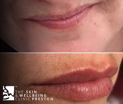 lauren 1ml lip filler treatment the