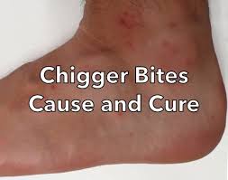 chigger bites cause and cure