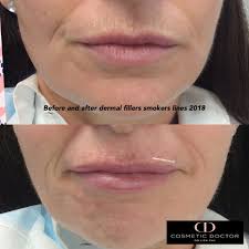 before after lip fillers smokers lines