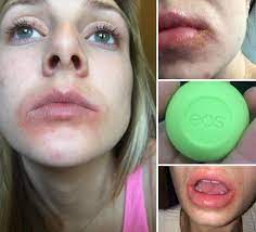 can eos lip balm cause rashes miley