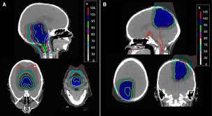 pencil beam scanning proton therapy for