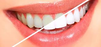 teeth whitening tips and services in