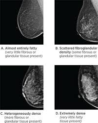 Breast Density What It Is And What It Means To You