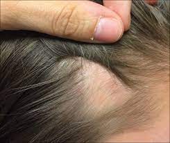 An itchy, flaky scalp may be another early sign of mpb. Patch Of Hair Loss On The Scalp Mdedge Dermatology