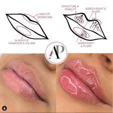 russian lip advanced dermal fillers