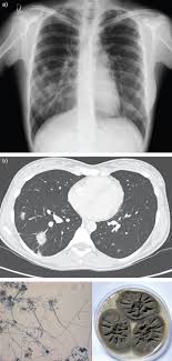 Pulmonary Phaeohyphomycosis A