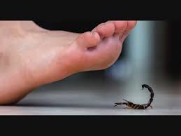 scorpion sting first aid treatment