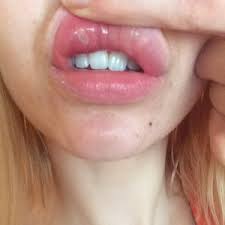 lip after juvederm injections