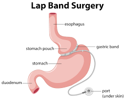 lap band surgery after gastric byp