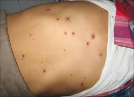 The parasites that cause swimmer's itch normally live in waterfowl and some mammals. Indian Journal Of Dermatology Venereology And Leprology Fever With Rash In A Child In India