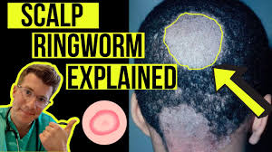 scalp ringworm tinea capitis