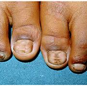 big toenails with habit tic deformity