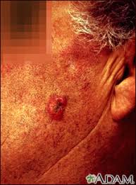 squamous cell skin cancer information