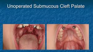 cd 660 exam 3 cleft palate flashcards