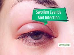 early morning swollen eyelids