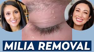 how to get rid of milia at home