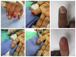 fingertip injury