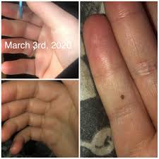 Normal moles don't typically turn into melanoma with 70% of. 21f I Woke Up To This Small Freckle On My Right Pinky Finger On The Pad In January 2020 Today I Woke Up And I Noticed It Looked Bigger I Looked Back