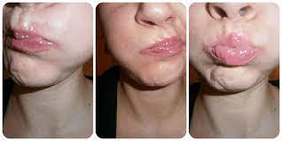 get fuller lips without fillers or surgery
