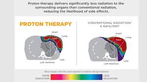 proton therapy for treating left sided